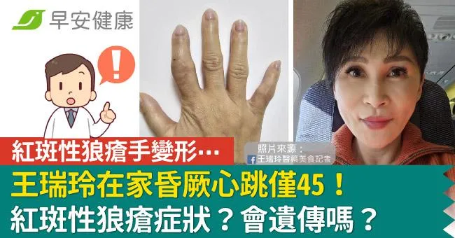 王瑞玲患病多年手指變形，在家昏厥心跳僅45！紅斑性狼瘡症狀？會遺傳嗎？