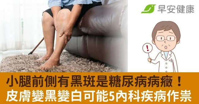 由內而來的變黑與變白－內科疾病造成的色素疾病