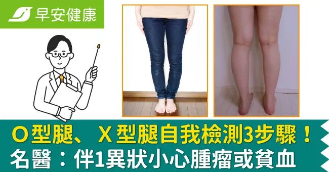 Ｏ型腿、Ｘ型腿自我檢測3步驟！名醫揭矯正標準，有1異狀恐是腫瘤或貧血