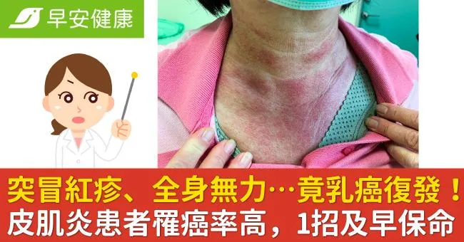 突冒紅疹、全身無力…竟乳癌復發！皮肌炎患者罹癌率高，1招及早保命