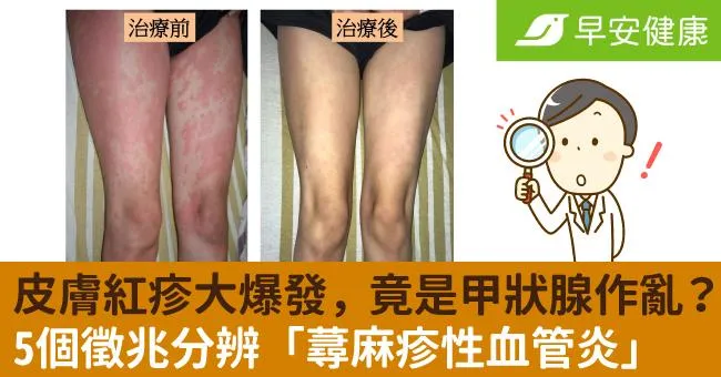 皮膚紅疹大爆發，竟是甲狀腺作亂？5個徵兆分辨「蕁麻疹性血管炎」