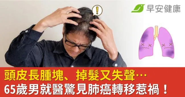 頭皮長腫塊、掉髮又失聲…65歲男就醫驚見肺癌轉移惹禍！