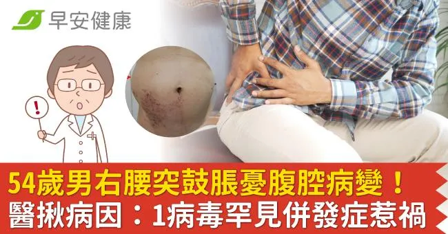 54歲男右腰突鼓脹憂腹腔病變！醫揪病因：1病毒罕見併發症惹禍