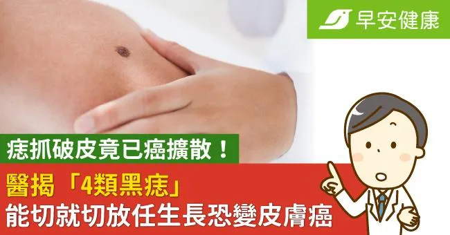 痣抓破皮竟已癌擴散！醫揭「4類黑痣」能切就切，放任生長恐變皮膚癌