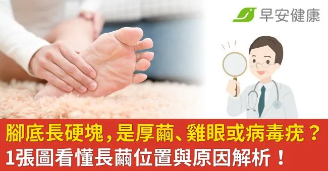 腳底長硬塊，是厚繭、雞眼或病毒疣？1張圖看懂長繭位置與原因解析！