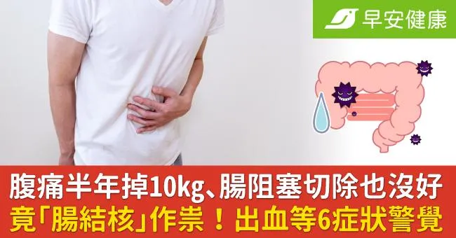 腹痛半年掉10kg、腸阻塞切除也沒好，竟「腸結核」作祟！出血等6症狀警覺