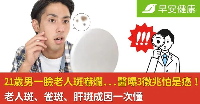 21歲男一臉老人斑嚇爛...醫曝3徵兆怕是癌！老人斑、雀斑、肝斑成因一次懂