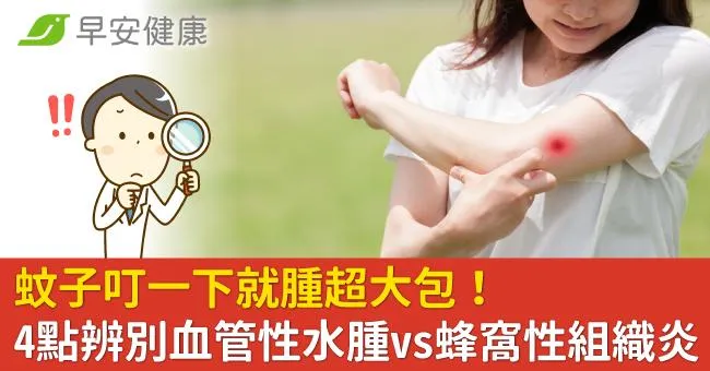 蚊子叮一下就腫超大包！是蜂窩性組織炎嗎？4個差異辨別血管性水腫