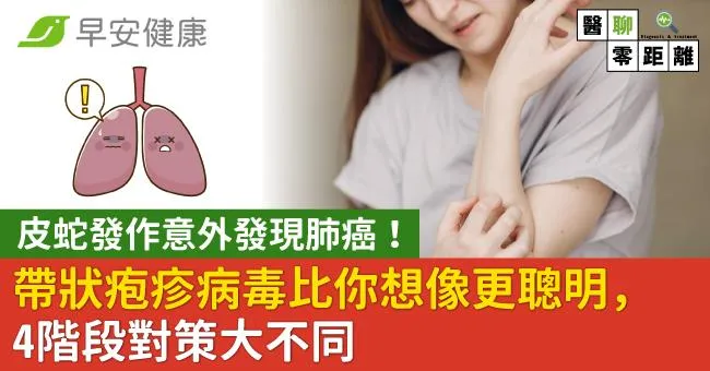 皮蛇發作意外發現肺癌！帶狀皰疹病毒比你想像更聰明，4階段對策大不同