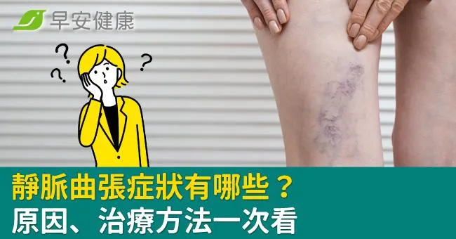 靜脈曲張症狀有哪些？原因、治療方法一次看