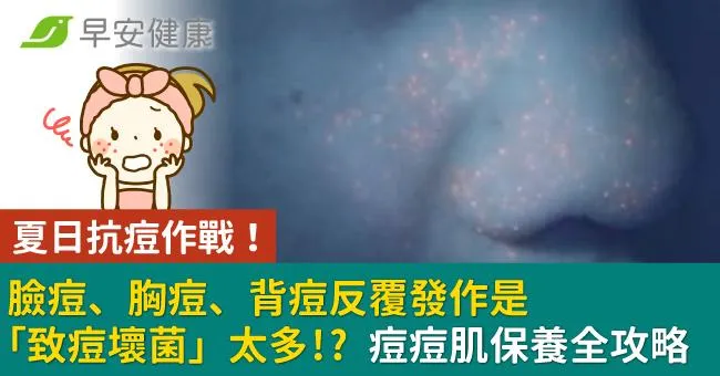 夏日抗痘作戰！臉痘、胸痘、背痘反覆發作是「致痘壞菌」太多 痘痘肌保養全攻略