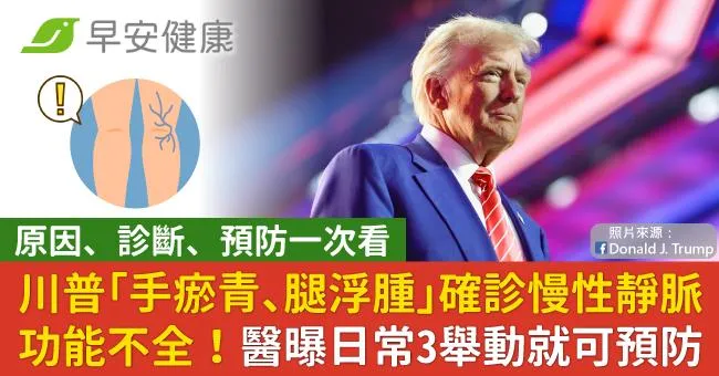 川普「手瘀青、腿浮腫」確診慢性靜脈功能不全！醫曝日常3舉動就可預防