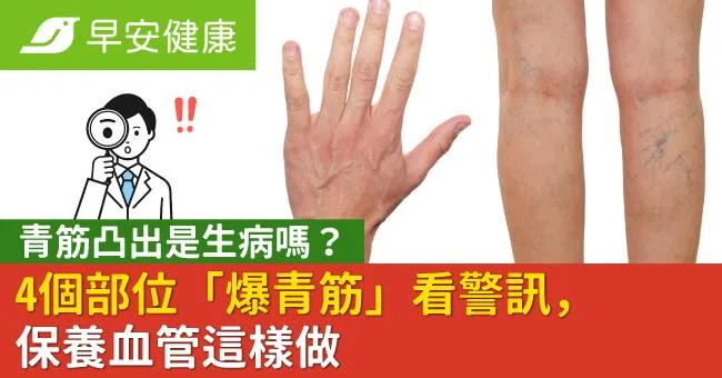青筋凸出是生病嗎？4個部位「爆青筋」看警訊，保養血管這樣做