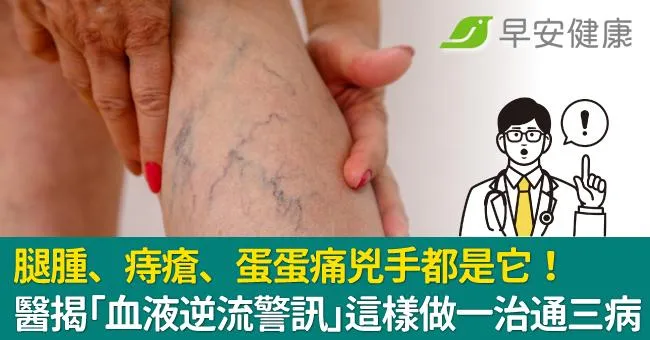 腿腫、痔瘡、蛋蛋痛兇手都是它！醫揭「血液逆流警訊」這樣做一治通三病