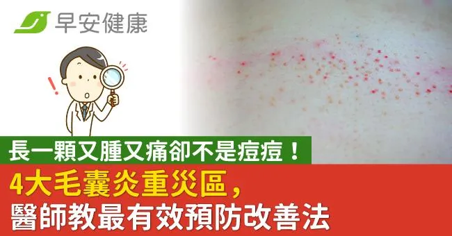 長一顆又腫又痛卻不是痘痘！4大毛囊炎重災區，醫師教最有效預防改善法