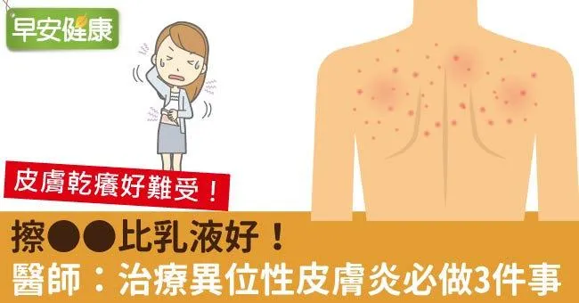 擦OO比乳液好！醫師：治療異位性皮膚炎必做3件事