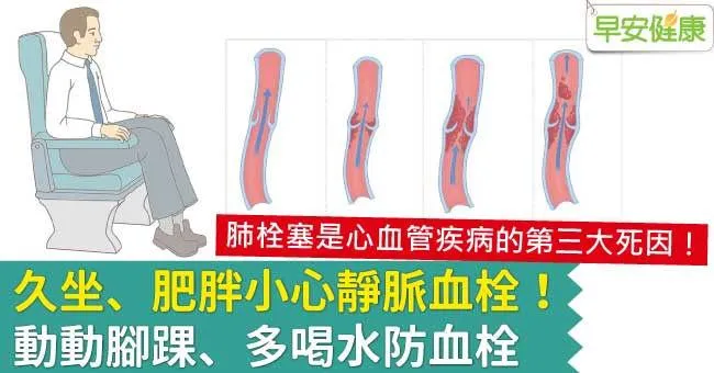 久坐、肥胖小心靜脈血栓！動動腳踝、多喝水防血栓