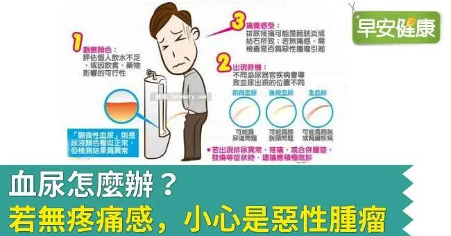 血尿怎麼辦？若無疼痛感，小心是惡性腫瘤