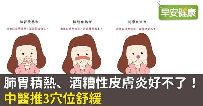 肺胃積熱、酒糟性皮膚炎好不了！中醫推3穴位舒緩