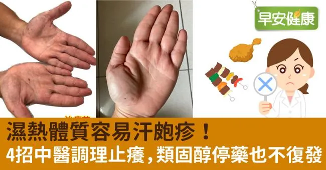 濕熱體質容易汗皰疹！4招中醫調理止癢，類固醇停藥也不復發