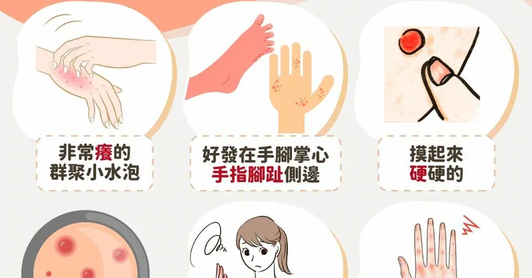 汗皰疹會自己好嗎？擦藥膏凡士林有用嗎？汗皰疹原因治療、初期症狀和香港腳有什麼不同？