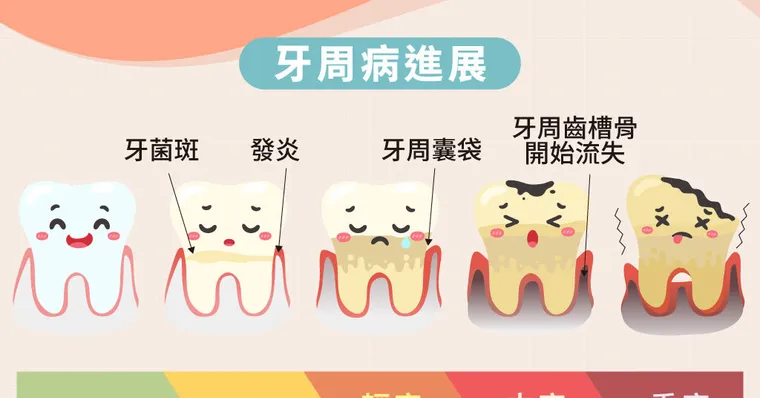 牙周病會傳染！牙周病會自己好嗎？症狀與治療費用全解析