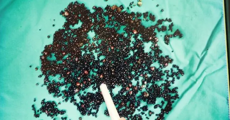 愛吃2種食物，他43歲長5千顆膽結石！上腹痛小心4種器官病變警訊