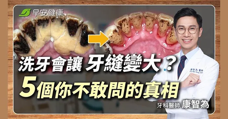 洗牙會痠痛、讓牙縫變大？牙醫師破解洗牙5大迷思、洗牙後2大保養關鍵