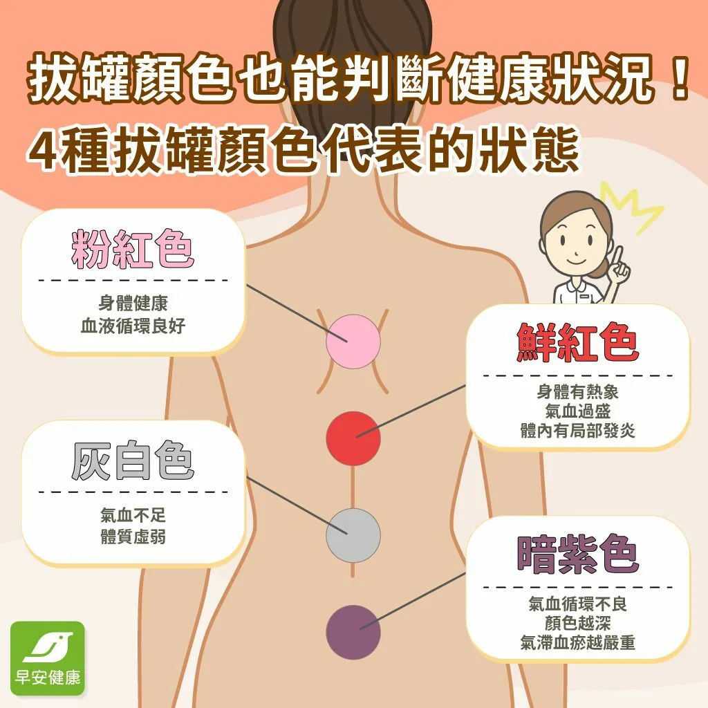 早安健康_拔罐顏色也能判斷健康狀況