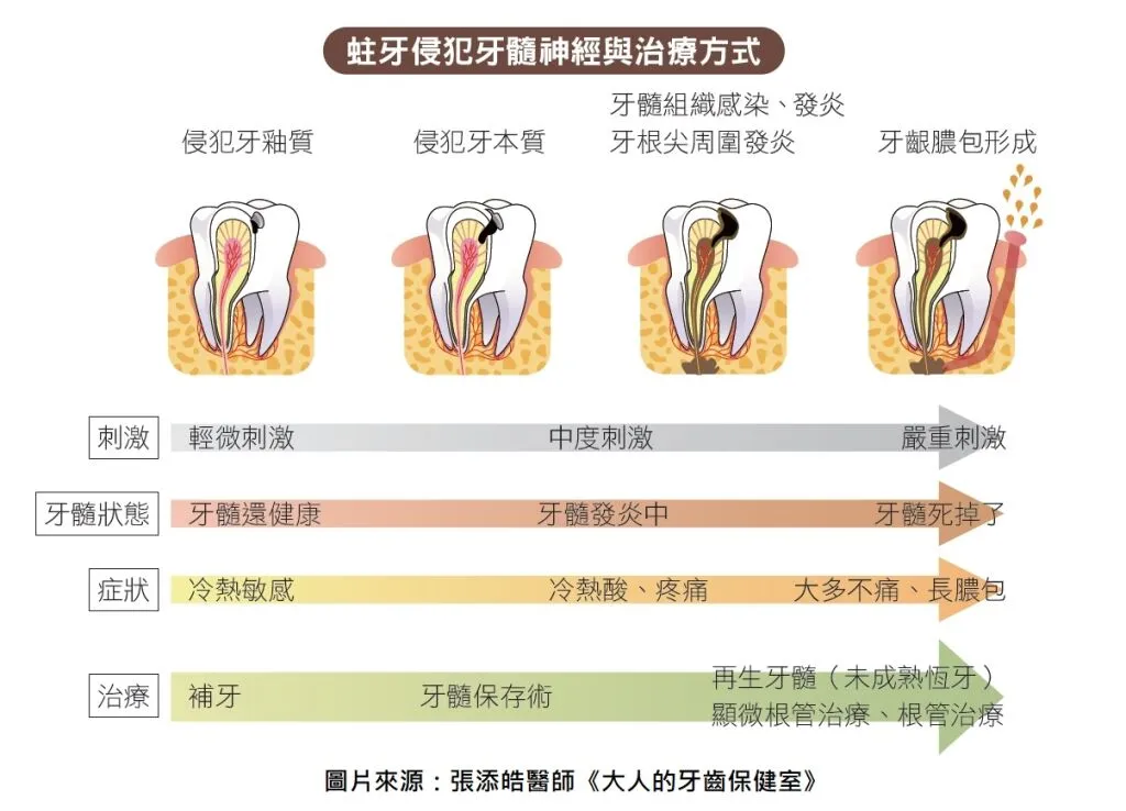 蛀牙侵犯牙髓神經與治療方式