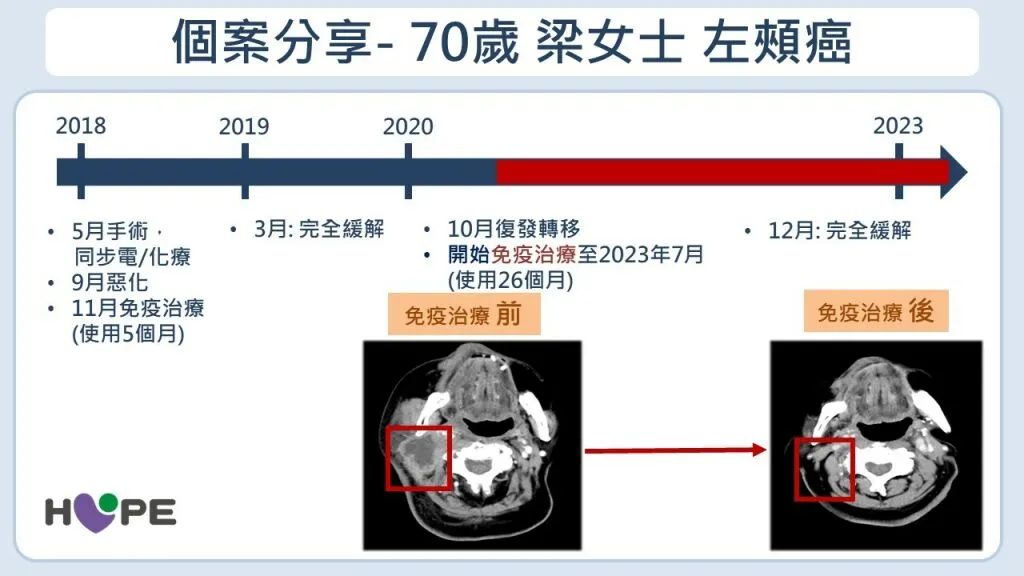 癌症希望基金會_70遂梁女士成功克服頭頸癌