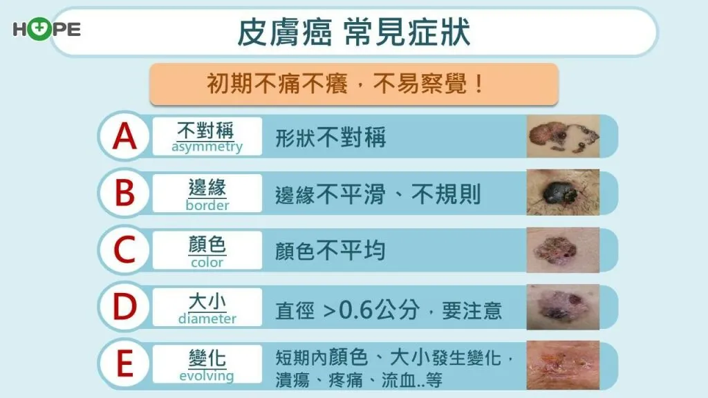 癌症希望基金會_皮膚癌常見症狀