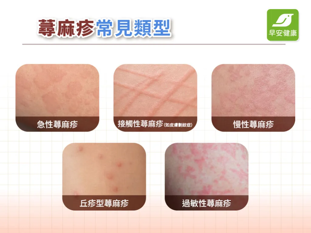 蕁麻疹類型-急性蕁麻疹-慢性蕁麻疹-接觸性蕁麻疹-丘疹型蕁麻疹-過敏性蕁麻疹
