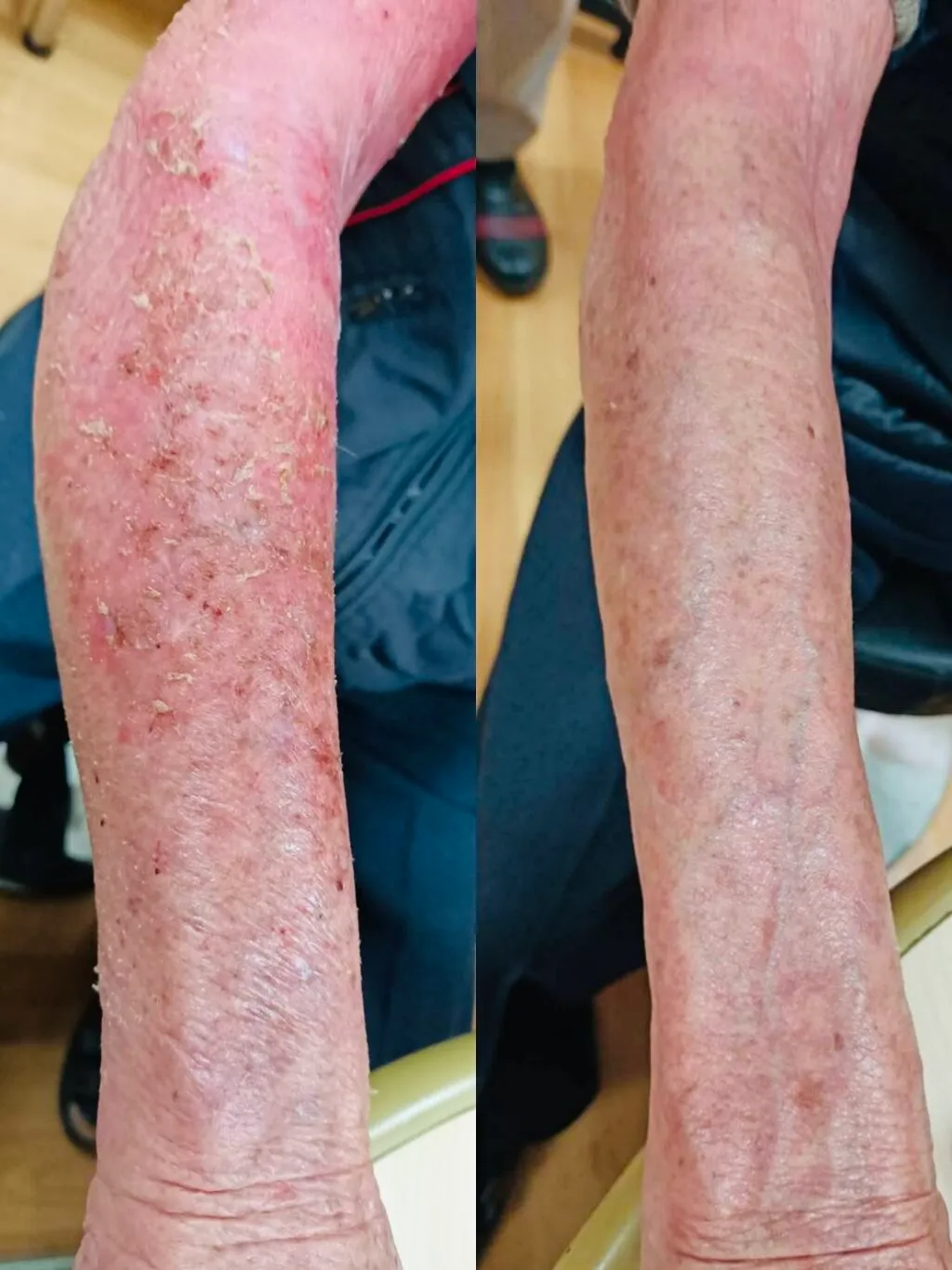 尿毒搔癢症的好發部位與特殊症狀