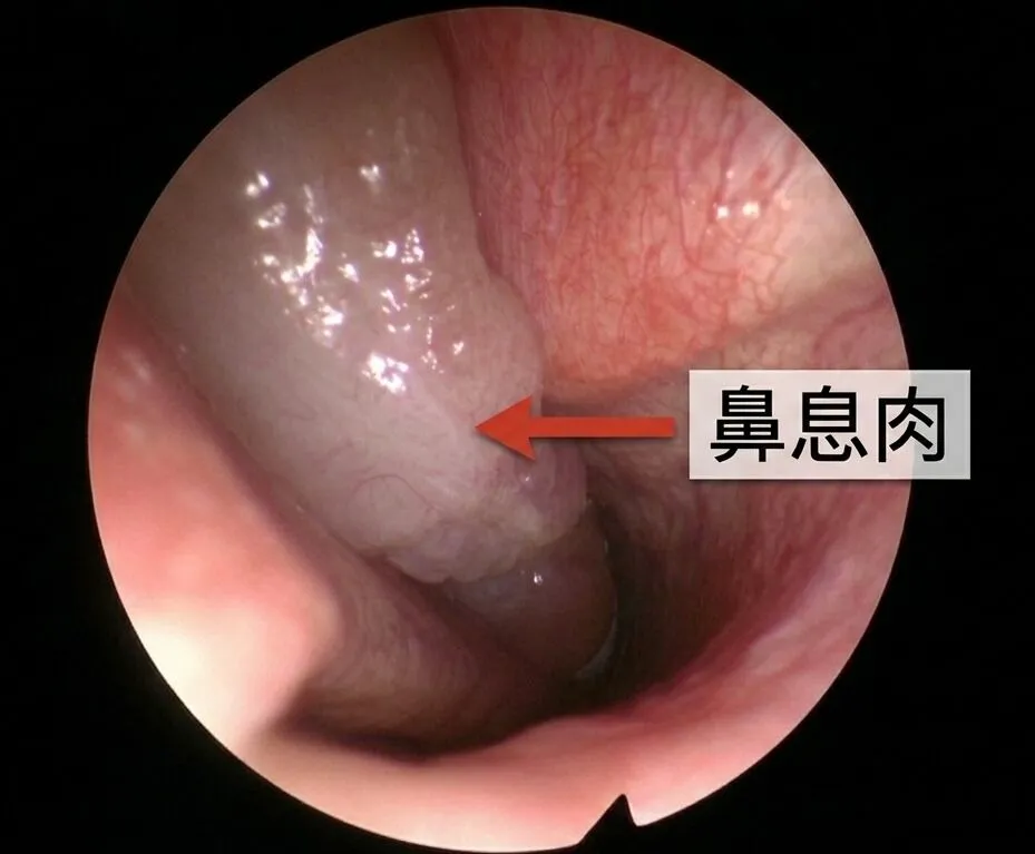 鼻息肉是增生的不健康組織，常會出現在有慢性鼻竇炎病友的身上，導致長期鼻塞