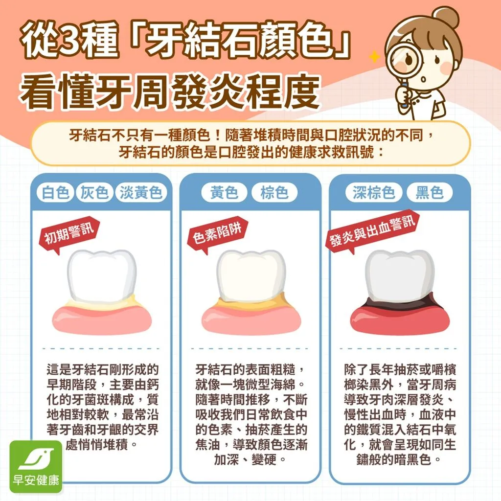 牙結石-牙結石顏色