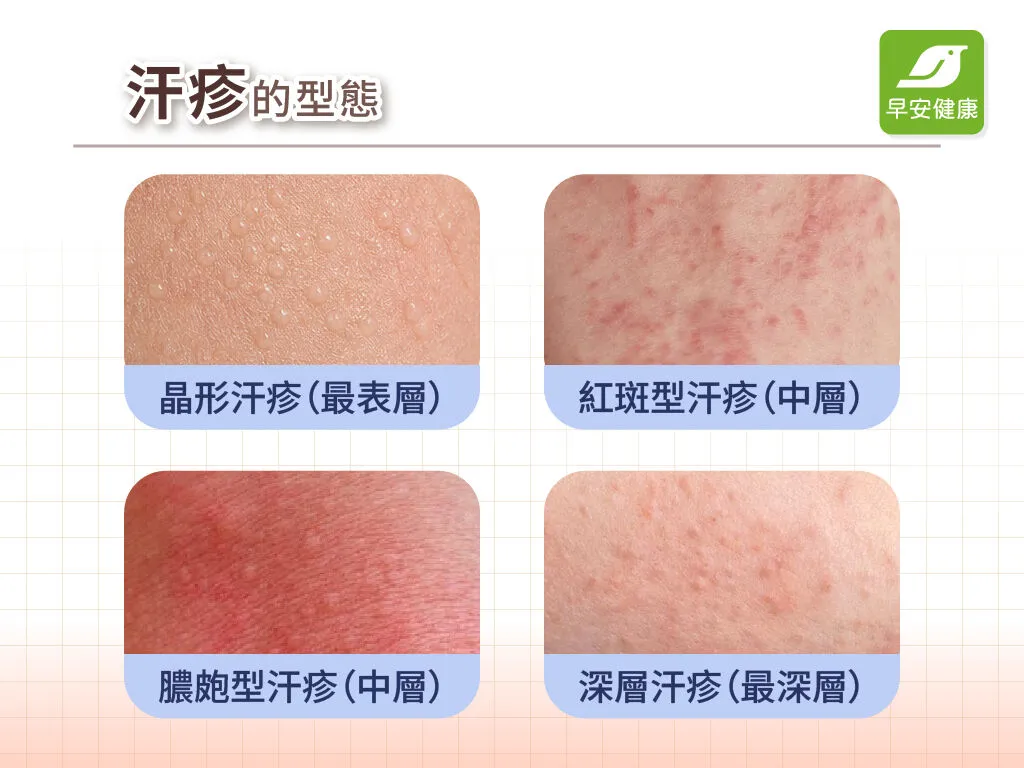 汗疹照片-汗疹型態-汗疹種類
