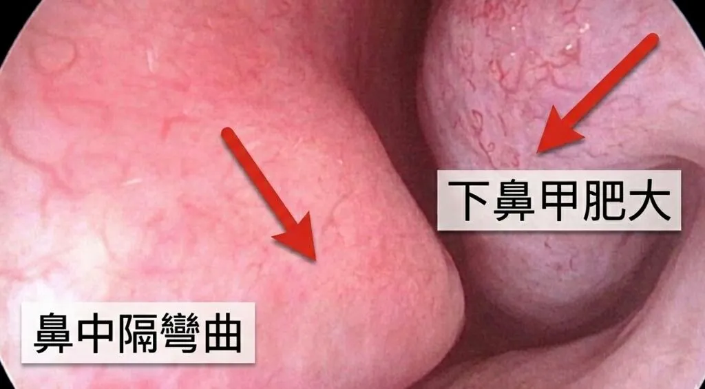 鼻中隔彎曲與下鼻甲肥大是造成長期鼻塞的原因之一