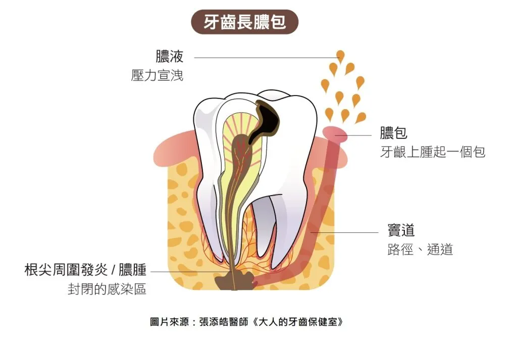 牙齒長膿包