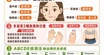 痣的位置代表什麼？這3處長痣要注意、自我檢測與安全除痣指南
