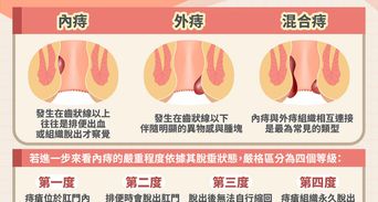 痔瘡會自己好嗎？痔瘡消腫止痛與藥膏手術照護秘訣全解析
