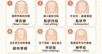 指甲凹陷怎麼辦？指甲出現橫紋、凹點、匙狀甲一次看懂