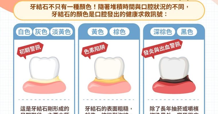 牙結石怎麼清？牙結石症狀、危害與預防全解析，刷牙刷得掉嗎？