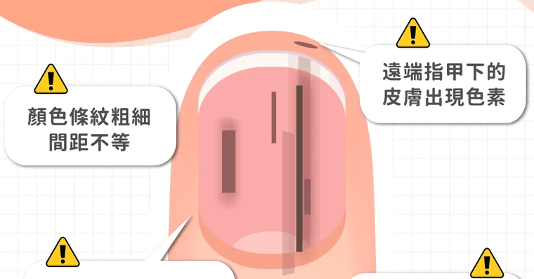 指甲黑線是癌症嗎？良性、惡性怎麼分？醫師曝4大危險特徵