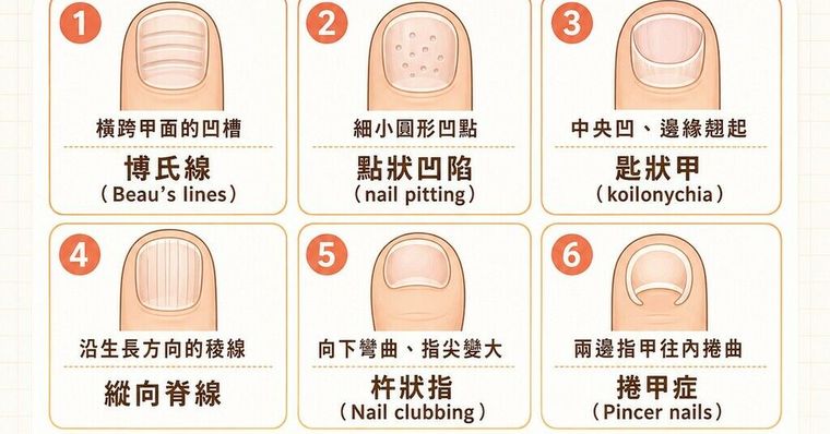 指甲凹陷怎麼辦？指甲出現橫紋、凹點、匙狀甲一次看懂