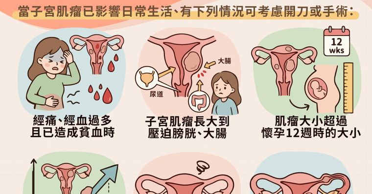 子宮肌瘤成因、症狀和最新治療趨勢，不開刀會自己好嗎？
