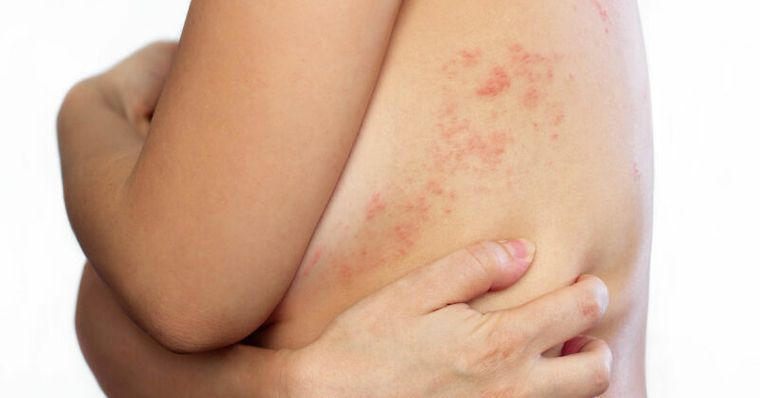 他帶狀皰疹痊癒卻連刷牙、吃飯都會痛！中醫「搜風藥」強效止痛