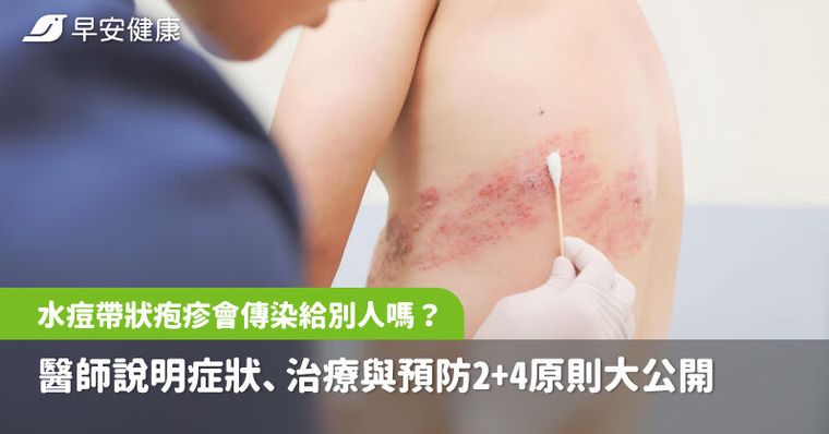 水痘-帶狀疱疹會傳染給別人嗎？醫師說明症狀、治療與預防2+4原則大公開