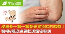 皮膚長一顆一顆竟是胃癌給的暗號！醫揭6種皮膚異狀透露癌警訊