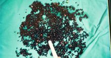 愛吃2種食物，他43歲長5千顆膽結石！上腹痛小心4種器官病變警訊